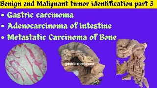 Gastric carcinoma Adenocarcinoma of Intestine Metastatic tumor of Bone identification Patho OSPE [upl. by Nytsud]