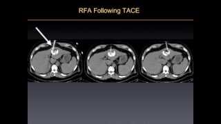 UCSF Radiology Killing Cancer Tumors w Radiofrequency Ablation Therapy [upl. by Annaehs]