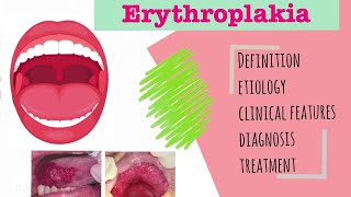 Erythroplakia  precancerous lesion  cause I clinical features I diagnosis I treatnent [upl. by Nuahsyd329]