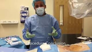 Spinal Cord Stimulator Trial Performed By Eduard Vaynberg MD [upl. by Caddaric]