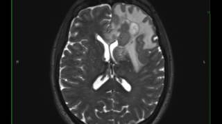 Grade 3 Anaplastic Astrocytoma [upl. by Nahtaneoj]