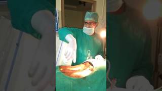 Radiofrequency ablation of L3 medial branch of L45 l5S1 facet joint for low back pain [upl. by Yetac421]