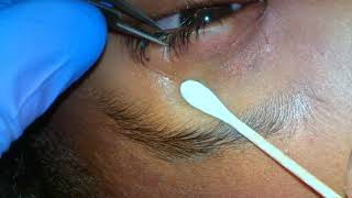 Botulinum toxin Botox injection to the lacrimal gland [upl. by Omura]