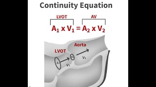 Doppler parameters in Aortic stenosis [upl. by Aleuname]