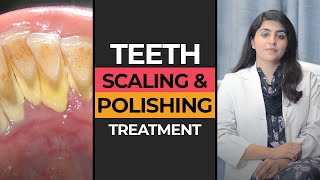 Teeth Scaling amp Polishing in Karachi  HASH DENTAL CLINIC [upl. by Ak]