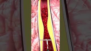 How Heart Stents Work 🤔 [upl. by Sucram]