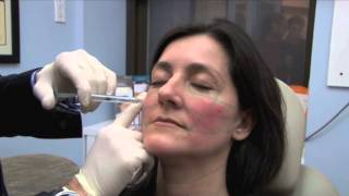 Dr Pearlman Demonstrates Juvéderm Voluma™ XC [upl. by Enida867]