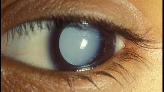 Cataract Aphakia and Pseudophakia Examination [upl. by Gurney]