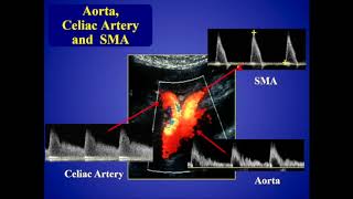 Mesenteric Ischemia [upl. by Dennie760]