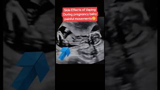 Side effects vaping baby painful movements in pregnancy🥲🥲viralvideo trending baby [upl. by Gent]