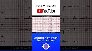 AV Block  1st Degree ECG shorts [upl. by Aysan]