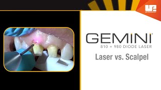 Gemini Clinical – Gingivectomy [upl. by Tiffa]