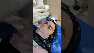 Xanthelasma Treatment with dengan Laser CO2 Fractional [upl. by Odnuges]