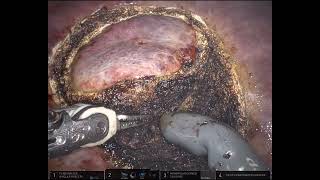 Robotic Microwave Ablation  Partial hepatectomy [upl. by Htial]