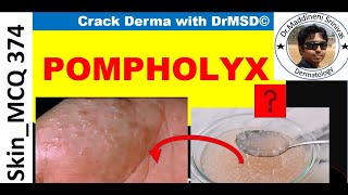 Dyshidrotic Eczema  POMPHOLYX  Causes Symptoms Diagnosis amp Treatment by Dr Maddineni Srinivas [upl. by Chyou]