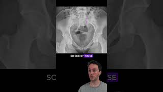 Sacral ala fracture with disruption of the arcuate lines radiology medicalstudent orthopedics [upl. by Birdt]