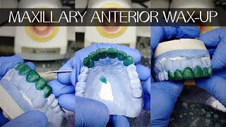 MAXILLARY ANTERIOR WAX UP FOR FULL ARCH REHABSTEP BY STEP CARVING WITH ANNOTATIONS [upl. by Lat190]