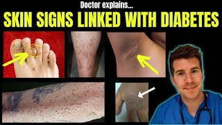 Doctor explains 12 SKIN CONDITIONS associated with DIABETES [upl. by Rayna]