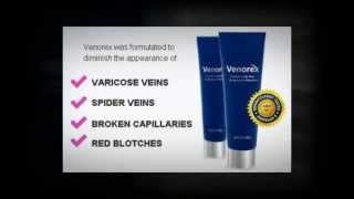 Venorex Varicose Vein Removal Cream Reviews [upl. by Derina]