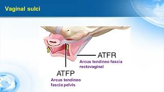 Pubourethral and urethropelvic ligaments plication rationale amp tecnique [upl. by Arammat]