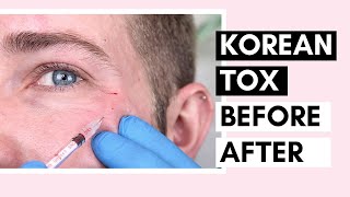 Korean Botulinum Toxin Before amp After  How To Dilute Toxins And Use For Forehead And Crow’s Feet [upl. by Ainolloppa]