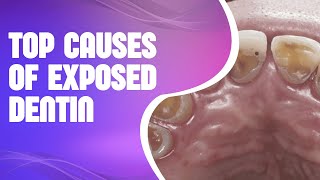 Top Causes of Exposed Dentin Signs Symptoms and Treatments [upl. by Nohtiek5]