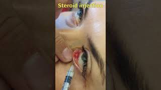 Chalazion treatment with steroid injection  Халязіон Інєкція стероїда [upl. by Regazzi]