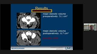 Unilateral hemilaminectomy for bilateral decompression in cervical spondylotic myelopathy [upl. by Chavey]