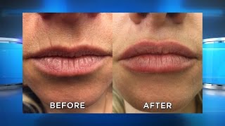 New Lip Filler Results [upl. by Assirk]