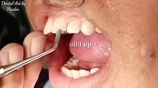 Light Cure Composite Filling  Front teeth filling  Composite Filling Procedure [upl. by Aihsenet722]