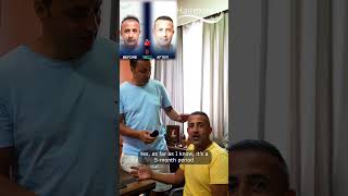 Mryılmaz achieved amazing hair transplant results after 5 months hairtransplantresults [upl. by Seigler]