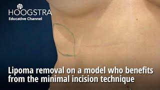 Lipoma removal on a model who benefits from the minimal incision technique  24148 [upl. by Mariandi]