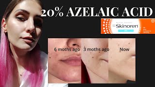 Skinoren Cream20Azelaic Acid Review How To Use Azelaic Acid With TretinoinSkinA Cream Retinoid [upl. by Vaclava773]