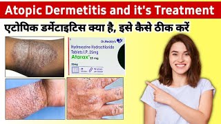 Atopic dermatitis treatment in hindi  hydralazine 25 mg tablet  Atarax injection  baby dermatitis [upl. by Nodanrb]