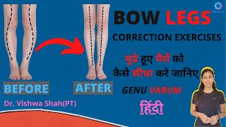 Bow Legs Correction Exercises  Bow knees workout  Knee pain relief treatment Genu Varum Arthritis [upl. by Nolyk447]