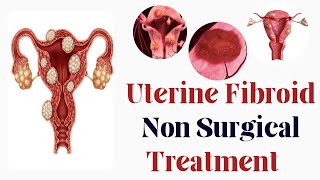 Treating Uterine Fibroid without Surgery  Embolization  uterinefibroidtreatment fibroidsurgery [upl. by Israeli724]