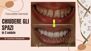 Caso di applicazione di faccette dentali  Cannizzo Studio Milano [upl. by Rachaba456]