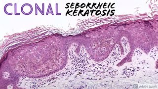 Clonal Seborrheic Keratosis Borst–Jadassohn Phenomenon 5Minute Pathology Pearls [upl. by Trinee943]