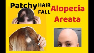 what is alopecia  What is Alopecia Areata  What is Patterned Hair loss a complete must see guide [upl. by Tegirb]