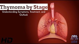 Decoding Thymoma A StagebyStage Guide to Symptoms amp Treatment [upl. by Leclair]