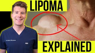 Doctor explains LIPOMA  Symptoms clinical photos and treatment [upl. by Airdnekal]