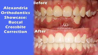 Alexandria Orthodontics Showcase Buccal crossbite [upl. by Nehemiah]