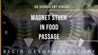 RIGID OESOPHAGOSCOPY  FOREIGN BODY IN OESOPHAGUS  Dr Sharad ENT Videos  youtubevideo surgery [upl. by Alyose350]