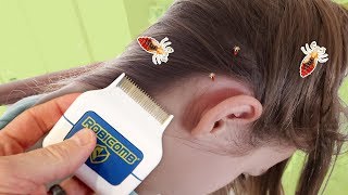 The Best Way to Remove Lice Honest RobiComb Review [upl. by Etnauq]