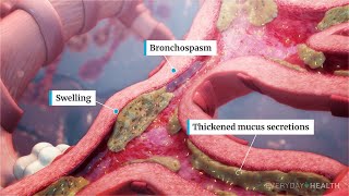 What Is Severe Asthma [upl. by Ataga]