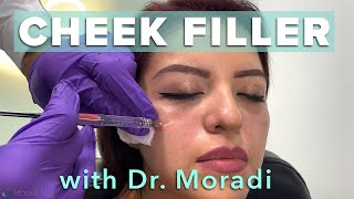 Watch This Patient Get Cheek Filler Before amp After Restylane Contour [upl. by Olram]