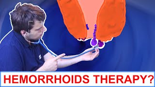 4 Things To Do About Hemorrhoids [upl. by Scheers662]