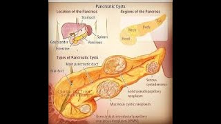 How to manage cystic lesion of the pancreas [upl. by Emyaj]