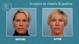 Sculptra filler for cheeks and jawline [upl. by Silliw]