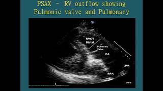 Normal Views  Transthoracic Echocardiogram TTE [upl. by Rand]